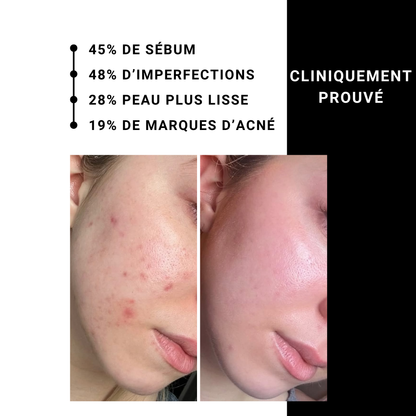 Sérum Charbon Actif – AHA 5% + BHA 2%